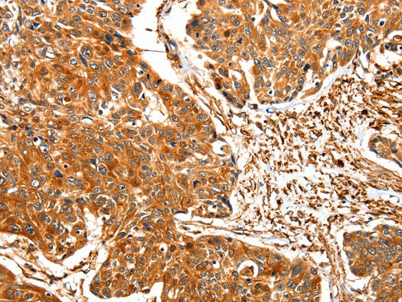 Immunohistochemistry of paraffin-embedded Human esophagus cancer using TPM2 Polyclonal Antibody at dilution of 1:30