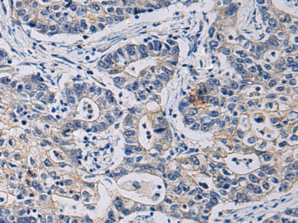 Immunohistochemistry of paraffin-embedded Human gastric cancer tissue  using CHST3 Polyclonal Antibody at dilution of 1:35(?200)