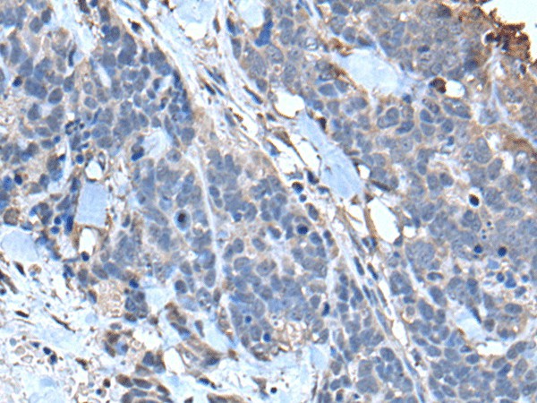 Immunohistochemistry of paraffin-embedded Human thyroid cancer tissue  using TPT1 Polyclonal Antibody at dilution of 1:85(?200)