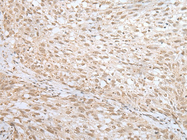 Immunohistochemistry of paraffin-embedded Human lung cancer tissue  using MORF4L1 Polyclonal Antibody at dilution of 1:45(?200)