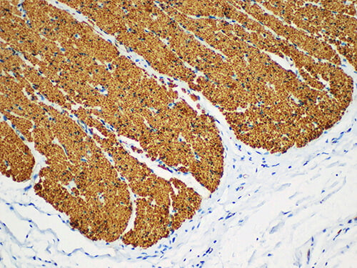 Immunohistochemistry of paraffinembedded Human colonic smooth muscle with Actin smooth muscle(SMA) Monoclonal Antibody(Antigen repaired by EDTA).