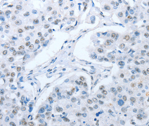 Immunohistochemistry of paraffin-embedded Human breast cancer tissue using ARHGEF2 Polyclonal Antibody at dilution 1:30