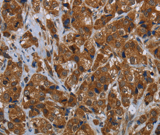 Immunohistochemistry of paraffin-embedded Human breast cancer tissue using ARHGEF12 Polyclonal Antibody at dilution 1:30