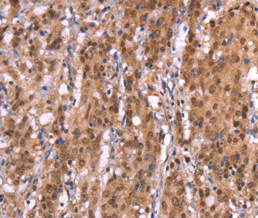 Immunohistochemistry of paraffin-embedded Human gasrtic cancer tissue using AMER1 Polyclonal Antibody at dilution 1:40