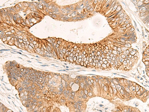 Immunohistochemistry of paraffin-embedded Human colorectal cancer tissue  using ABHD2 Polyclonal Antibody at dilution of 1:50(?200)