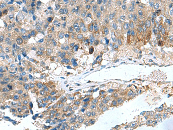 Immunohistochemistry of paraffin-embedded Human liver cancer tissue  using HSD11B1 Polyclonal Antibody at dilution of 1:70(?200)