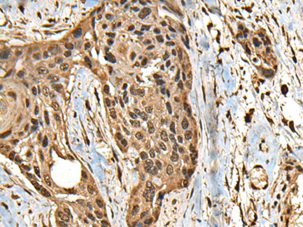 Immunohistochemistry of paraffin-embedded Human esophagus cancer tissue  using CCDC113 Polyclonal Antibody at dilution of 1:65(?200)