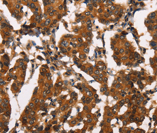 Immunohistochemistry of paraffin-embedded Human breast cancer tissue using ATRN Polyclonal Antibody at dilution 1:50