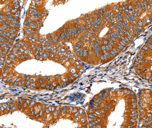 Immunohistochemistry of paraffin-embedded Human cervical cancer tissue using FGFR1 Polyclonal Antibody at dilution 1:60