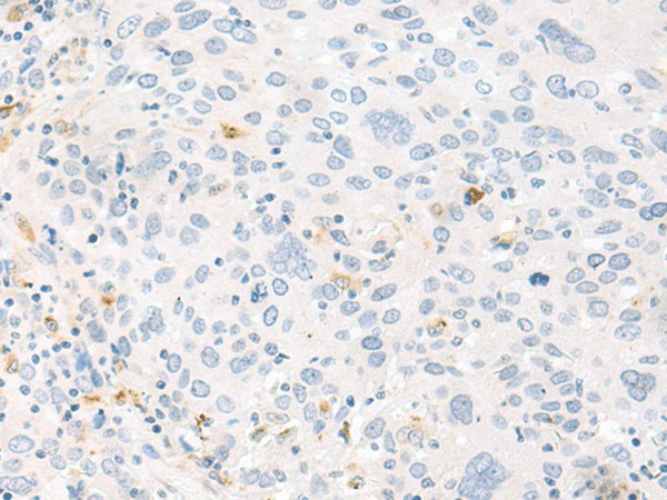 Immunohistochemistry of paraffin-embedded Human cervical cancer tissue  using FABP4 Polyclonal Antibody at dilution of 1:60(?200)