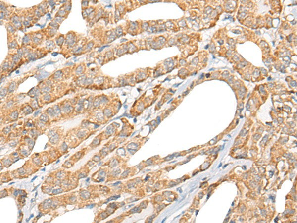 Immunohistochemistry of paraffin-embedded Human thyroid cancer tissue  using CCL5 Polyclonal Antibody at dilution of 1:50(?200)