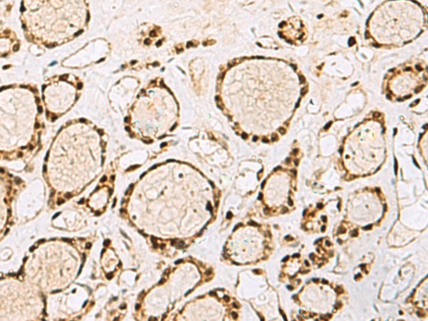 Immunohistochemistry of paraffin-embedded Human thyroid cancer tissue  using XRCC4 Polyclonal Antibody at dilution of 1:60(?200)