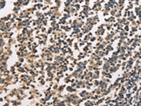 Immunohistochemistry of paraffin-embedded Human tonsil tissue  using ZFYVE19  Polyclonal Antibody at dilution of 1:60(?200)