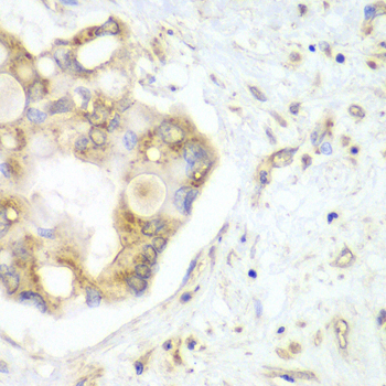 Immunohistochemistry of paraffin-embedded human liver cancer using VTI1B Polyclonal Antibody at dilution of 1:100 (40x lens).Perform microwave antigen retrieval with 10 mM PBS buffer pH 7.2 before commencing with IHC staining protocol.