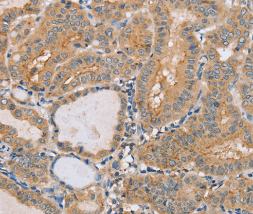 Immunohistochemistry of paraffin-embedded Human thyroid cancer tissue using PTPN4 Polyclonal Antibody at dilution 1:40