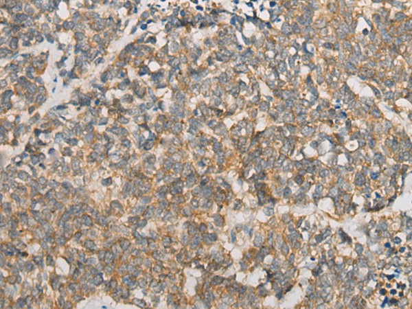 Immunohistochemistry of paraffin-embedded Human lung cancer tissue  using ATXN7 Polyclonal Antibody at dilution of 1:60(?200)