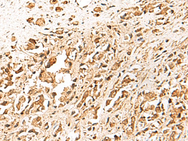 Immunohistochemistry of paraffin-embedded Human prost ate cancer tissue  using TERF1 Polyclonal Antibody at dilution of 1:30(?200)