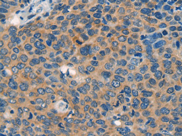 Immunohistochemistry of paraffin-embedded Human cervical cancer tissue  using CASP4 Polyclonal Antibody at dilution of 1:40(?200)