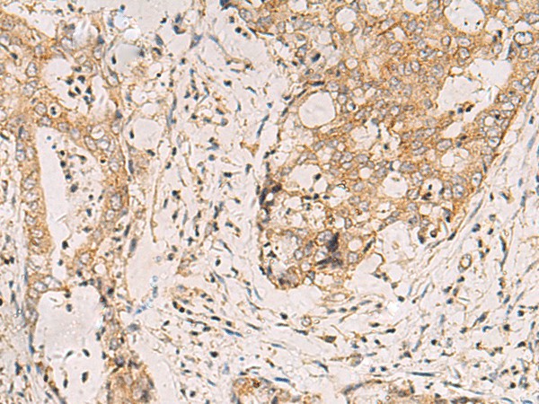 Immunohistochemistry of paraffin-embedded Human cervical cancer tissue  using FYCO1 Polyclonal Antibody at dilution of 1:110(?200)