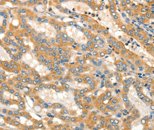 Immunohistochemistry of paraffin-embedded Human thyroid cancer tissue using ADCY3 Polyclonal Antibody at dilution 1:30