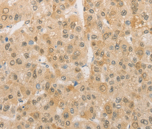 Immunohistochemistry of paraffin-embedded Human liver cancer using PGK2 Polyclonal Antibody at dilution of 1:50