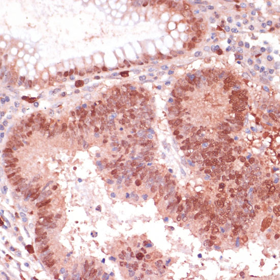 Immunohistochemistry of paraffin-embedded Human colon carcinoma using S100P Polyclonal Antibody at dilution of  1:100 (40x lens).