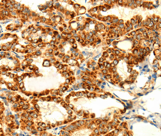 Immunohistochemistry of paraffin-embedded Human thyroid cancer using DIABLO Polyclonal Antibody at dilution of 1:70