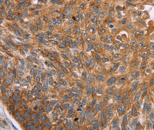 Immunohistochemistry of paraffin-embedded Human esophagus cancer tissue using PMPCB Polyclonal Antibody at dilution 1:50