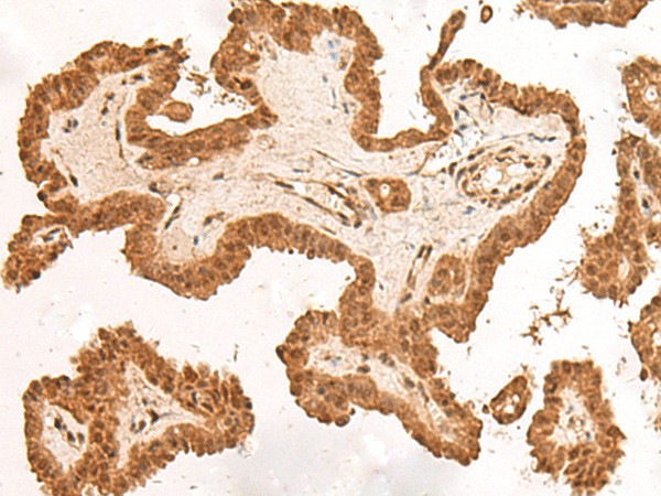 Immunohistochemistry of paraffin-embedded Human thyroid cancer tissue  using ARMC8 Polyclonal Antibody at dilution of 1:40(?200)