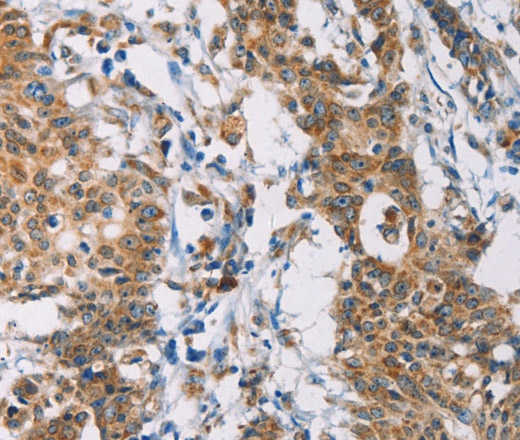 Immunohistochemistry of paraffin-embedded Human gastric cancer tissue using CERK Polyclonal Antibody at dilution 1:30