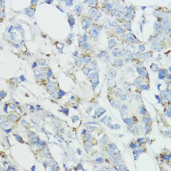 Immunohistochemistry of paraffin-embedded Human mammary cancer using SOD3 Polyclonal Antibody at dilution of 1:100 (40x lens).