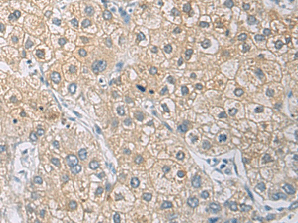 Immunohistochemistry of paraffin-embedded Human liver cancer tissue  using IL1RN Polyclonal Antibody at dilution of 1:50(?200)