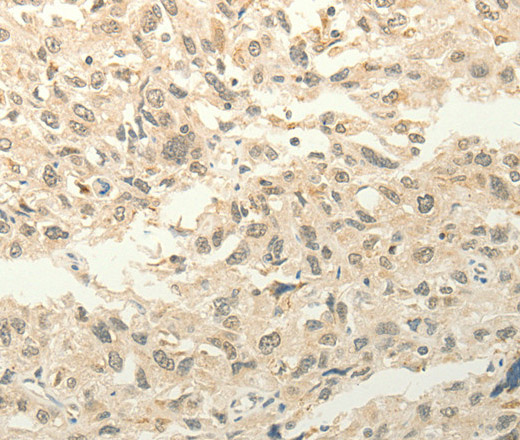 Immunohistochemistry of paraffin-embedded Human esophagus cancer tissue using FZD8 Polyclonal Antibody at dilution 1:50