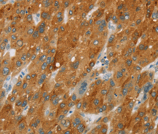 Immunohistochemistry of paraffin-embedded Human liver cancer using CYP2E1 Polyclonal Antibody at dilution of 1:30