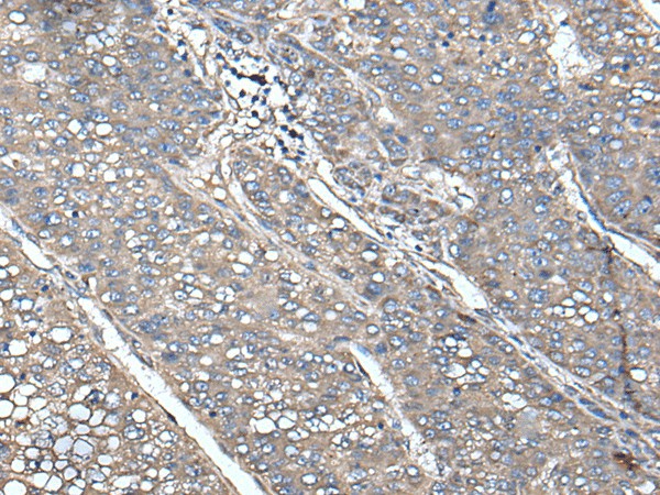 Immunohistochemistry of paraffin-embedded Human liver cancer tissue  using UNC13B Polyclonal Antibody at dilution of 1:85(?200)