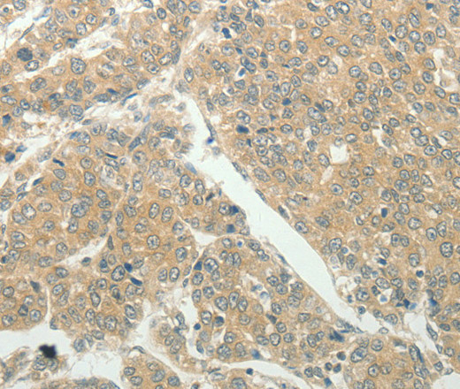 Immunohistochemistry of paraffin-embedded Human liver cancer tissue using SLC8A3 Polyclonal Antibody at dilution 1:50