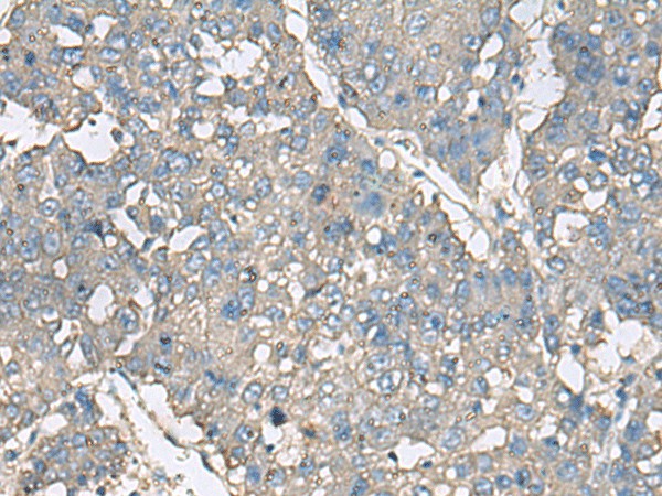 Immunohistochemistry of paraffin-embedded Human liver cancer tissue  using TNF Polyclonal Antibody at dilution of 1:40(?200)