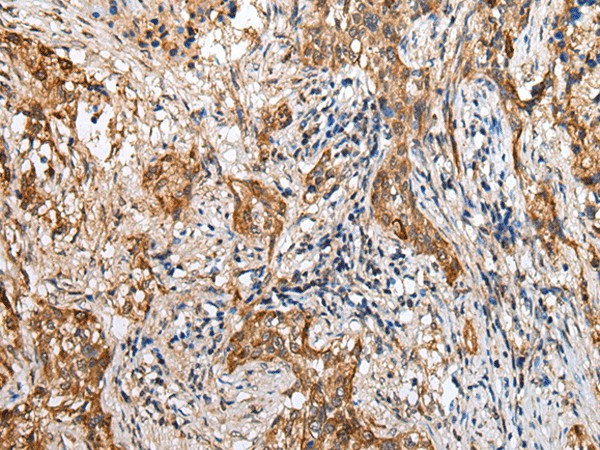 Immunohistochemistry of paraffin-embedded Human lung cancer tissue  using LYPD4 Polyclonal Antibody at dilution of 1:25(?200)