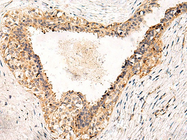 Immunohistochemistry of paraffin-embedded Human breast cancer tissue  using GPR152 Polyclonal Antibody at dilution of 1:55(?200)