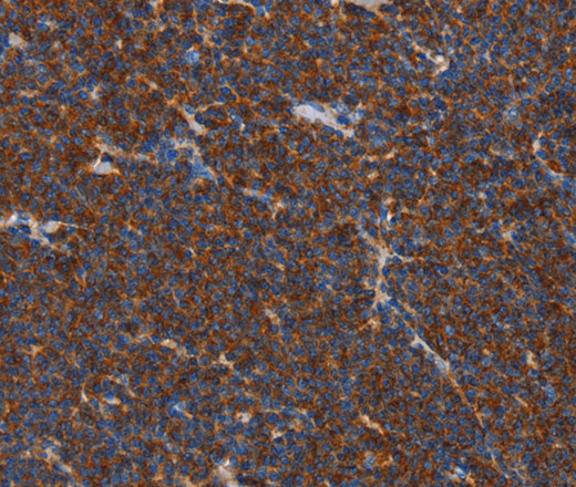 Immunohistochemistry of paraffin-embedded Human lymphoma tissue using FNK Polyclonal Antibody at dilution 1:40