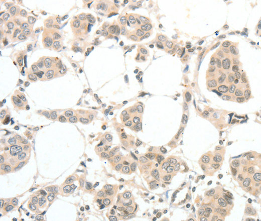 Immunohistochemistry of paraffin-embedded Human breast cancer tissue using TSPYL2 Polyclonal Antibody at dilution 1:30