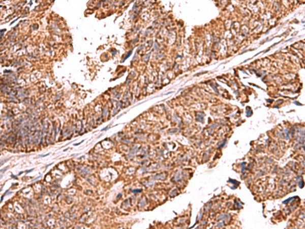 Immunohistochemistry of paraffin-embedded Human colorectal cancer tissue  using UBAC1 Polyclonal Antibody at dilution of 1:60(?200)