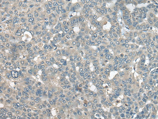 Immunohistochemistry of paraffin-embedded Human liver cancer tissue  using UCN3 Polyclonal Antibody at dilution of 1:55(?200)