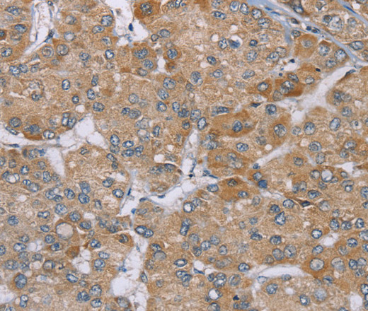 Immunohistochemistry of paraffin-embedded Human liver cancer using ACTN2 Polyclonal Antibody at dilution of 1:30