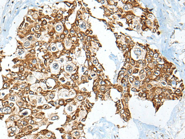 Immunohistochemistry of paraffin-embedded Human prost ate cancer tissue  using USP12 Polyclonal Antibody at dilution of 1:35(?200)