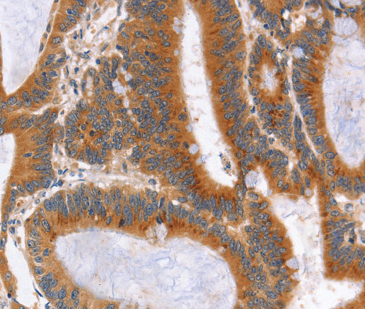 Immunohistochemistry of paraffin-embedded Human colon cancer tissue using NOD1 Polyclonal Antibody at dilution 1:50