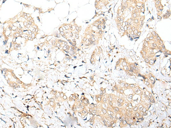 Immunohistochemistry of paraffin-embedded Human breast cancer tissue  using FOXO4 Polyclonal Antibody at dilution of 1:70(?200)