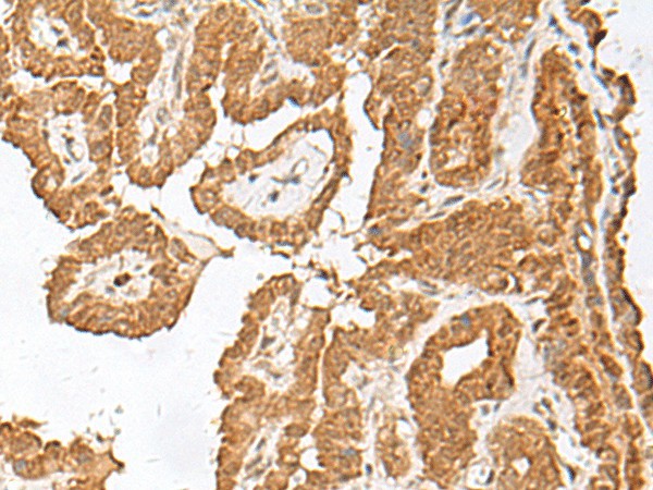 Immunohistochemistry of paraffin-embedded Human thyroid cancer tissue  using FGF13 Polyclonal Antibody at dilution of 1:45(?200)