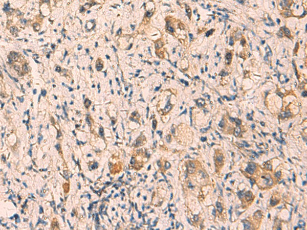 Immunohistochemistry of paraffin-embedded Human liver cancer tissue  using CRYM Polyclonal Antibody at dilution of 1:65(?200)