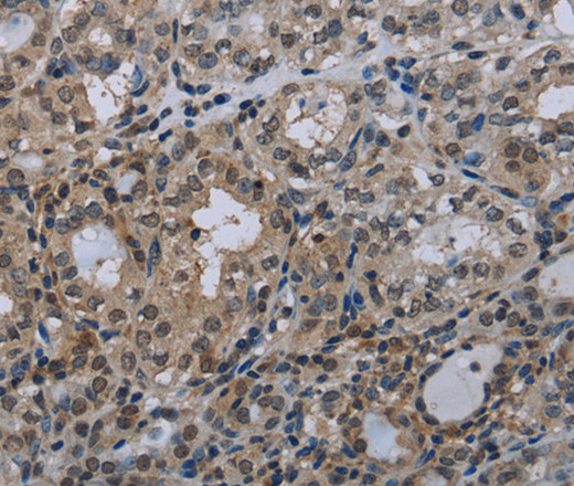 Immunohistochemistry of paraffin-embedded Human thyroid cancer tissue using Connexin 47 Polyclonal Antibody at dilution 1:40